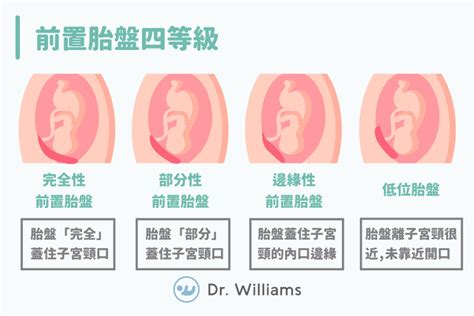 前置胎盤剝離|認識「前置胎盤」4種型態及主要症狀｜Mombaby 媽 